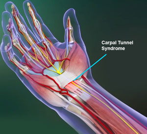 Carpal Tunnel Syndrom