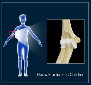 Elbow Fractures In Children