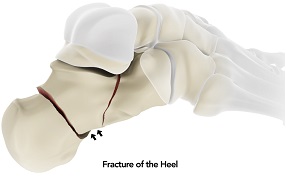 Fracture Of The Heel