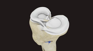 Meniscus Repair