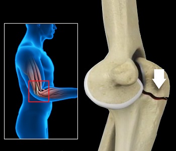 Olecranon Fractures-