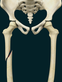 Pediatric Thigh Bone Fracture