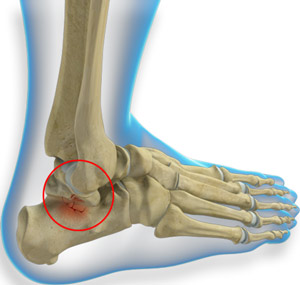 Talus Fracture